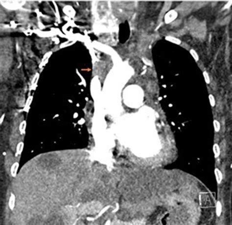 Superior Vena Cava Occlusion Without Malignancy Acp Hospitalist