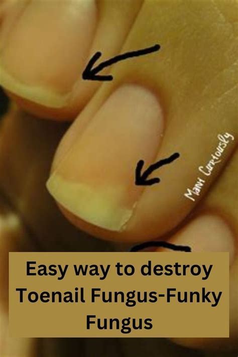 How To Help A Toenail Grow Back Quickly 15 Steps With Pictures Artofit