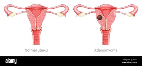 Adenomyoma Adenomiosi Anatomia Umana Organi Del Sistema Riproduttivo