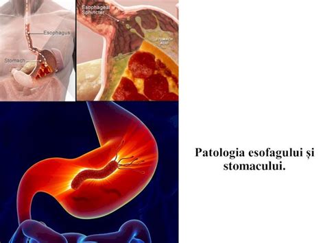 Pdf Patologia Esofagului I Stomacului Ulcerul