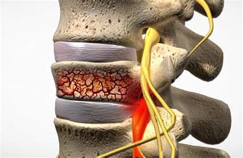 Healing Stress Fractures In The Spine What You Need To Know