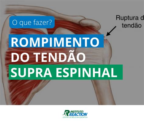 Tendinopatia Supra Espinhal Afastamento Trabalho REVOEDUCA