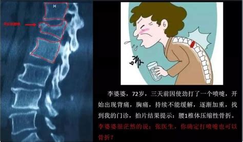 並非所有腰痛都是腰椎間盤突出（下） 每日頭條