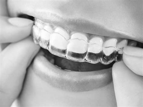 Clear Aligners Smile Dental Clinic