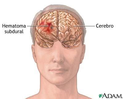 Hipertensión Endocraneana HIPERTENSION ENDOCRANEANA