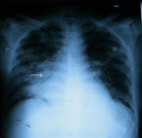 Aspirated Material Through Malpositioned Nasogastric Tube In Right Main