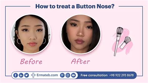 Button nose rhinoplasty | Best Cost & Hospital