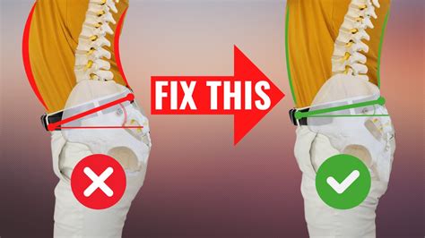 Fix Anterior Pelvic Tilt In 100 Seconds Perfect Pelvic Posture