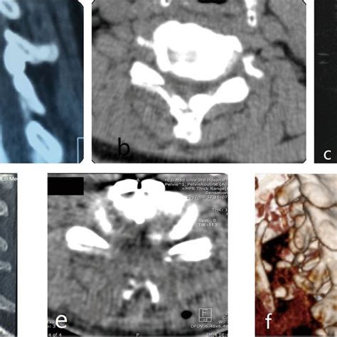 Preoperative And Postoperative Imaging Comparison Preoperative