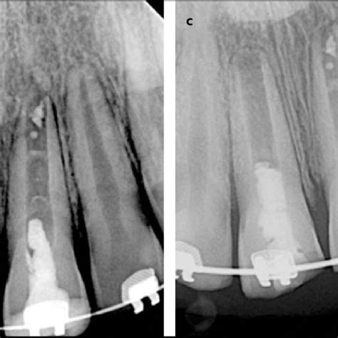 A Pa Radiograph Showing A Gutta Percha Point Tracing The Sinus Tract