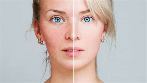 Acne Prone Skin - Healthgk