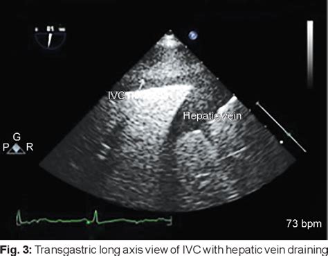 Figure 3 From A Rare Case Report Of Intravenous Leiomyomatosis With