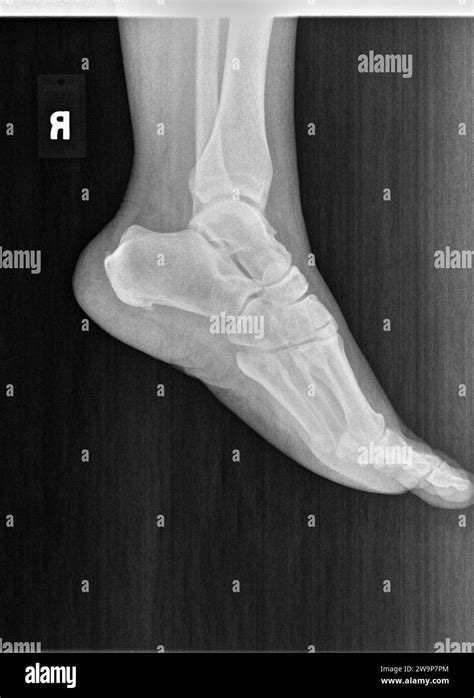 Film Xray Or Radiograph Of A Normal Foot Ankle And Leg Lateral View