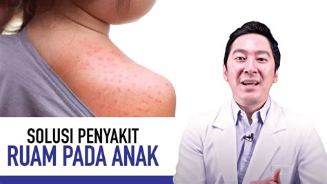 Ruam Pada Anak Gejala Penyebab Dan Cara Mengatasi Kata Dokter Youtube