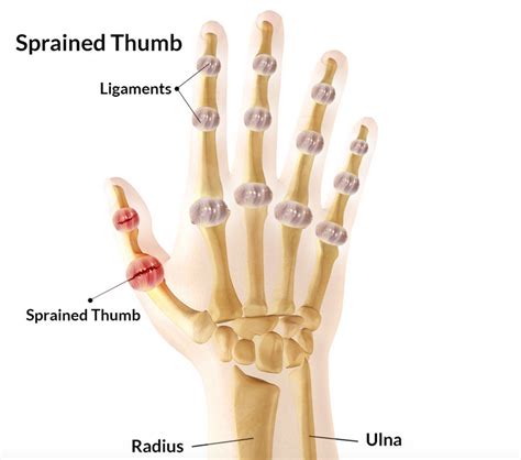 Sprained Thumb Symptoms Treatment Rehabilitation And Taping Sportsmd