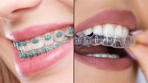 Diferencia Entre Brackets Y Alineadores Gu A Completa