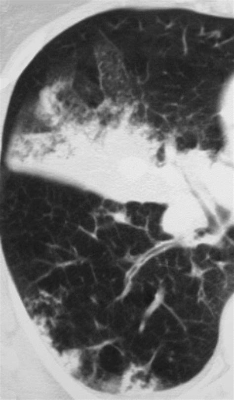 Pulmonary Artery Aneurysms And Pseudoaneurysms In Adults Findings At