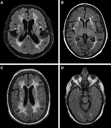 Cerebral Autosomal Dominant Arteriopathy With Subcortical Infarcts And Leukoencephalopathy Stroke