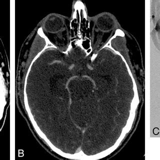 A 67 Year Old Woman Who Presented With Sudden Onset Of Severe Headache