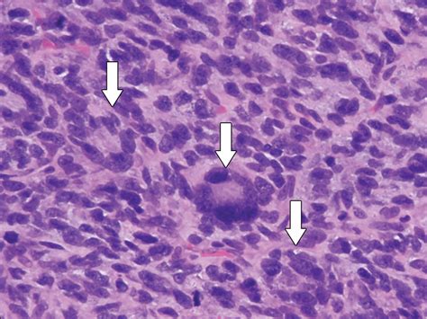 Phyllodes Tumor Of The Breast Ultrasound Pathology Correlation Ajr