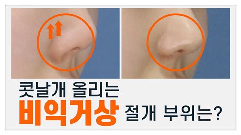 콧날개 올리는 수술 비익거상 절개 부위와 수술 흉터가 궁금하다면 히트성형외과 코성형 Youtube