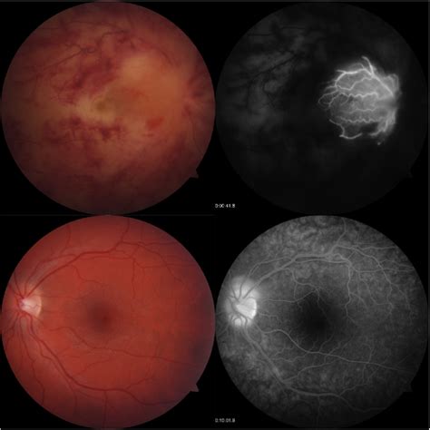 Fundus Photographs And Fluorescein Angiography Performed Early In