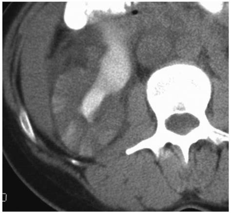 Glomerulonephritis Ultrasound