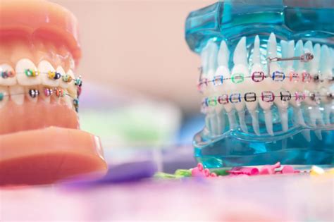 Types Of Orthodontic Appliances Alan J Schwartz Dds Pc