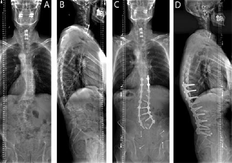 A Preoperative Anteroposterior And B Lateral Full Spine X Rays