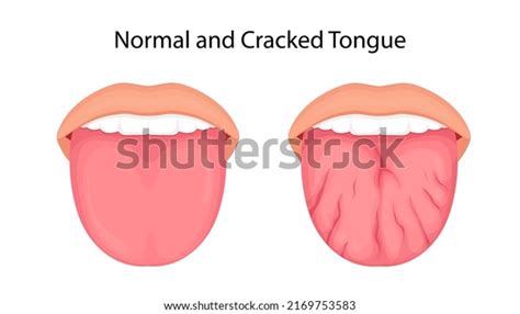 2.118 Mouth Sores Tongue Images, Stock Photos, 3D objects, & Vectors ...