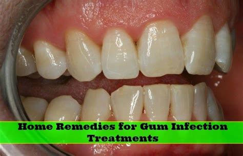 Home Remedies For Gum Infection Treatments