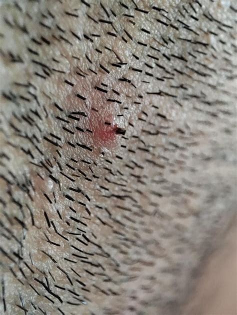 A compound hair with inflamed follicle i pulled off my beard. : r/popping