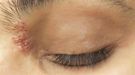 Shingles On The Face What It Looks Like And How To Care For It