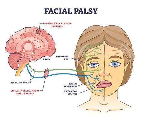 Bells Palsy What Is It And How To Treat It Gulfphysio