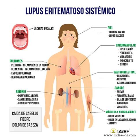 Lupus Eritematoso Sist Mico Qu Es S Ntomas Y Tratamiento