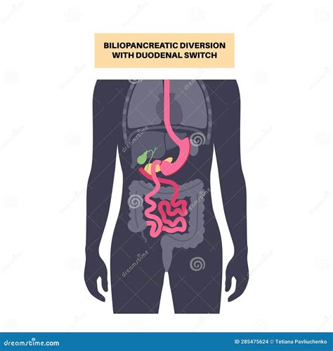 Biliopancreatic Diversion Procedure Vector Illustration Cartoondealer