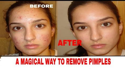 A Magical Way To Remove Pimples 365 Reporter