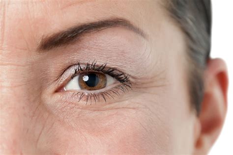 How Long Does It Take To Recover From Eyelid Surgery