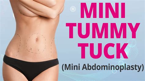 Mini Tummy Tuck Explained Mini Abdominoplasty Edelstein Cosmetic Toronto Youtube