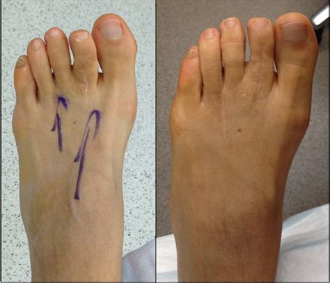 List 94 Pictures Plastic Surgery To Make Feet Smaller Updated