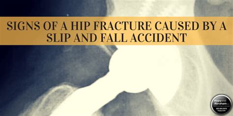 Slip and Fall Hip Fracture Symptoms and Recoveries | Hupy and Abraham, S.C.