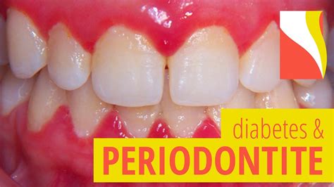 Doen A Periodontal E Diabetes Riscos Youtube