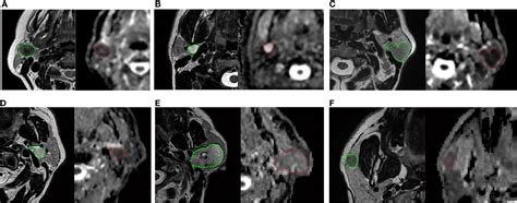 Parotid Gland Tumor Mri