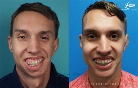 Hemifacial Microsomia Goldenhar Syndrome Before And After Photos Law Plastic Surgery