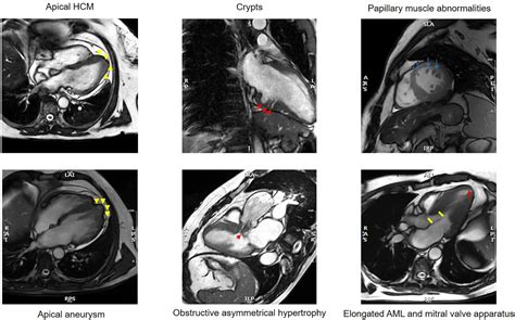 Diagnosis And Management Of Patients With Left Ventricular Hypertrophy