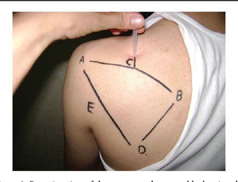 Figure From Suprascapular Nerve Block Followed By Codman S