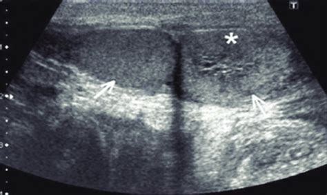 Transverse Extended Field Of View Image Of The Scrotum Showing Right