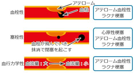 脳梗塞第1弾 もっと頭部に強くなろう！脳梗塞を基礎から覚えよう！ Radiographica