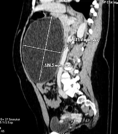 Computed Tomography Reconstruction Of The Intra Abdominal Cyst Side