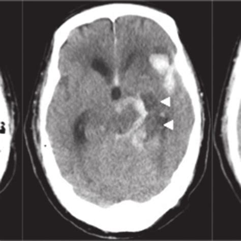 CT On Admission Shows Subarachnoid Hemorrhage In The Left Side Of The